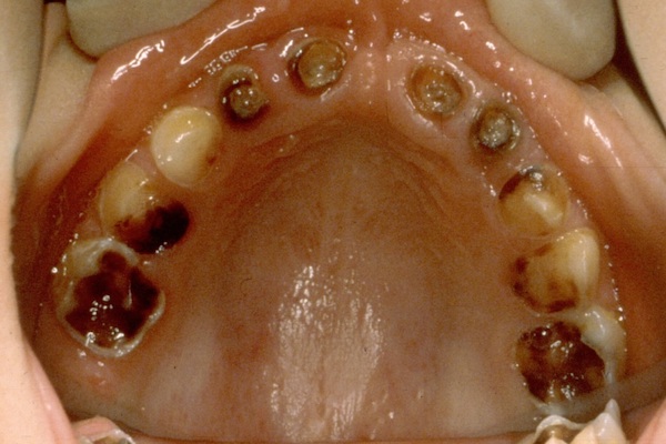 Primer plano de dientes y encías.