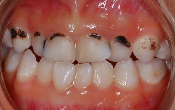 Primer plano de dientes con caries dental avanzada.