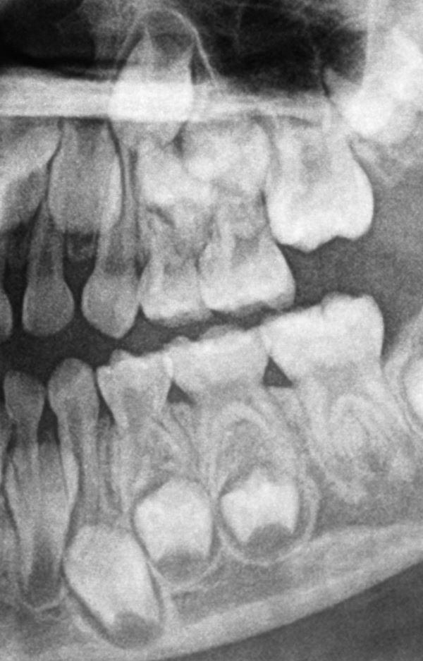 X-ray of baby teeth.