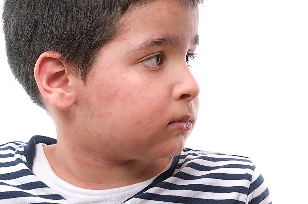 A boy with a rash on his face.