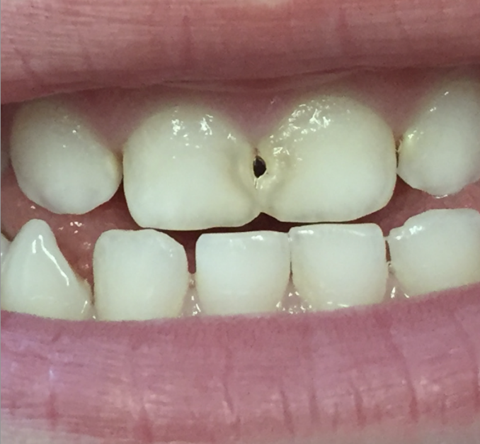 Teeth without SDF treatment.