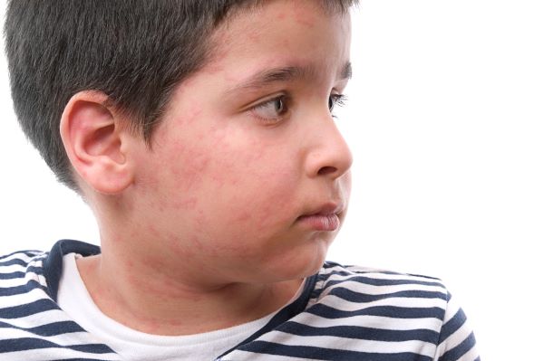 A young boy with a rash on his face most likely from an allergic reaction.